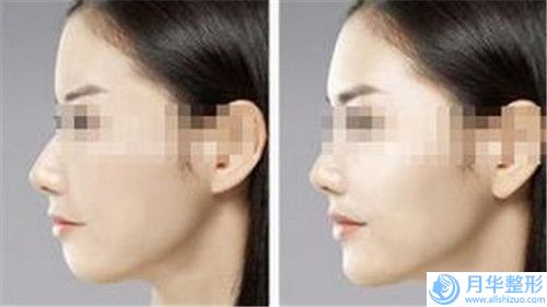 鞍山乳房畸形矯正術(shù)美容手術(shù)適合人群