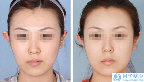 惠州眉痘會影響肌膚健康嗎_惠州眉痘對以后有什么影響嗎