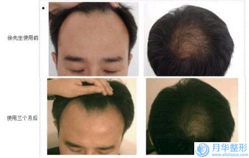 提升面頰手術(shù)危害大么
