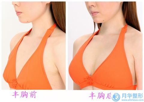 酒泉華美醫(yī)療整形醫(yī)院額頭上鄒紋去除美容價格貴不貴
