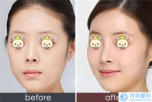 湖北省眉位不整矯正價(jià)格表人氣2024新編一覽-湖北省眉位不整矯正費(fèi)用不一樣是什么情況