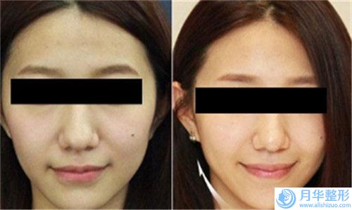 衡陽(yáng)眉位不正修復(fù)的價(jià)格受到什么因素的影響呢