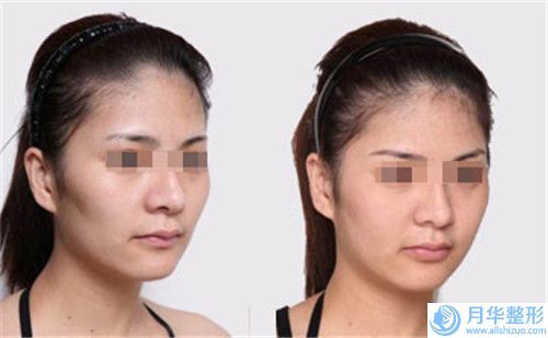 亳州熙諾醫(yī)療美容兔唇手術(shù)價(jià)格大概是多少錢