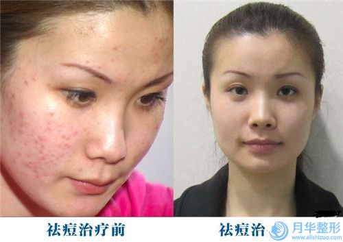 巴中太陽(yáng)穴玻尿酸填充費(fèi)用與哪些因素有關(guān)呢