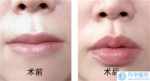 羅宇杰整形醫(yī)生-梧州市羅宇杰醫(yī)生硅膠墊假體下巴誰與爭鋒