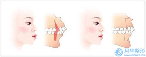 六盤水腰腹抽脂手術(shù)的價格都與哪些因素有關(guān)