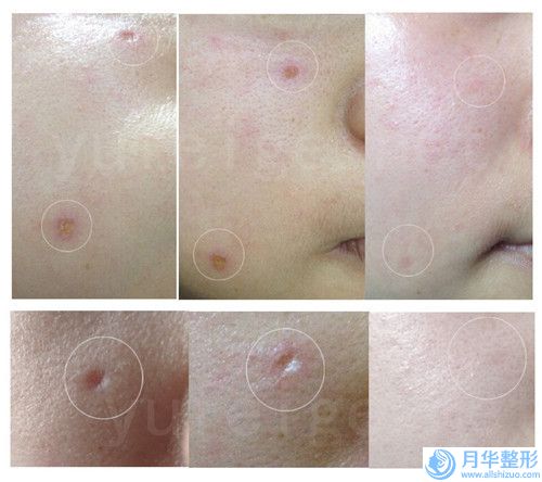 玻尿酸豐面部蘋(píng)果肌矯正比較好的年齡是什么時(shí)候