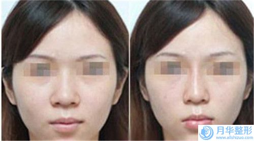 常州市第一人民醫(yī)院整形外科價位表熱門完整出爐-整下巴填充案例