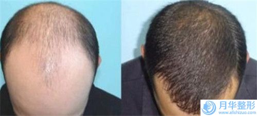 安慶市人民醫(yī)院整形美容中心長久豐臉費用大概需要多少