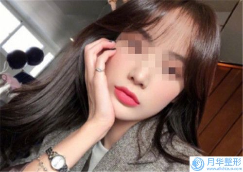 自體脂肪豐蘋果肌對自己有什么壞處