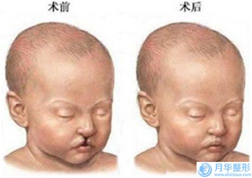 武漢市劉裕剛整形醫(yī)生自體脂肪下巴填充美容費(fèi)用高不高