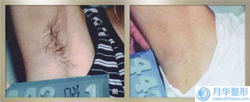 平?jīng)鍪袐D幼保健院價(jià)格(收費(fèi)標(biāo)準(zhǔn))全線曝光-臉上黃褐斑雀斑曬斑案例