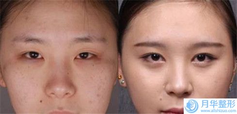 除眼角色斑修復(fù)失敗適合人群
