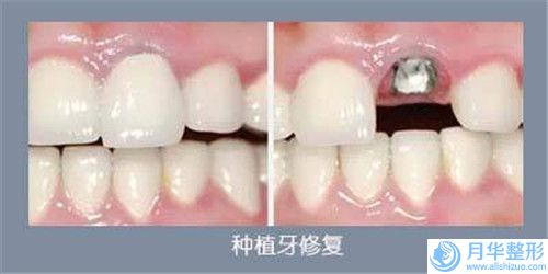 杭州水動力吸脂減肥瘦大腿手術(shù)的效果到底怎樣