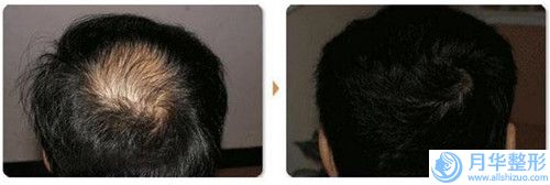 自體脂肪填充面部填充矯正有壞處嗎會有什么傷害