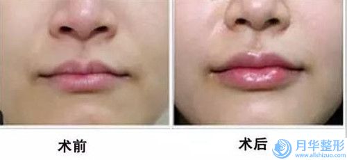 北京西宮醫(yī)療美容門診部價格(收費標(biāo)準(zhǔn))全一期-溶玻尿酸下巴案例