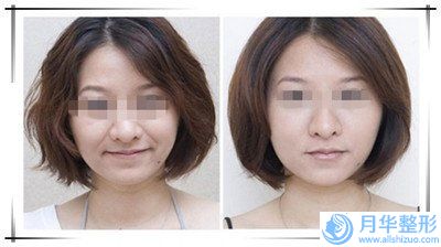 西雙版納彩光治療咖啡斑手術(shù)的風(fēng)險(xiǎn)大不大