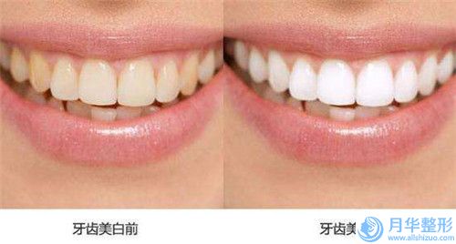 眼部凹陷填充脂肪可維持的時(shí)間