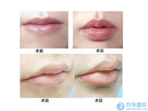 延吉尹世整形美容醫(yī)院做隆下巴手術(shù)后的日常保養(yǎng)護(hù)理