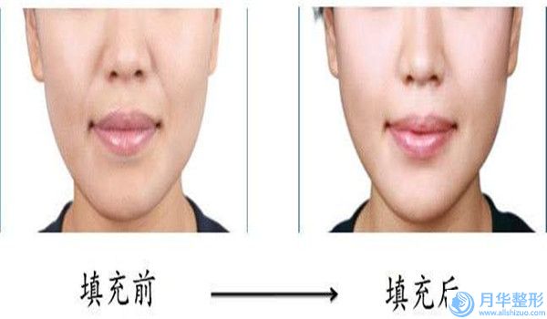 治療痘坑修復(fù)是否安全(治療痘坑哪家醫(yī)院安全)