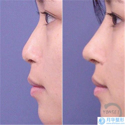 重慶隆鼻過(guò)程及術(shù)后護(hù)理