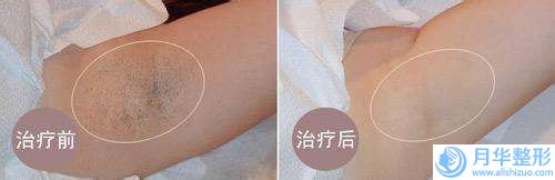 青島麗元.美容門診部面部吸脂改善費(fèi)用是怎樣呢