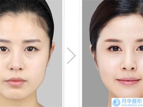 秦皇島第一醫(yī)院整形美容科價格(費(fèi)用)清單2024在線咨詢-霧眉絲霧眉案例