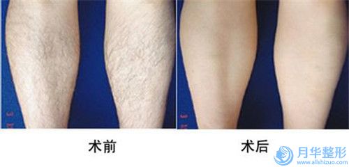 山東省鄭建新整形醫(yī)生臉部假體填充手術(shù)一般都需要多少錢