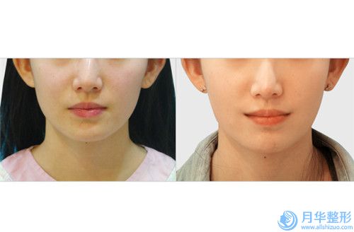 鞍山豪美康健醫(yī)療美容醫(yī)院雙下巴緊致費(fèi)用怎么算呢