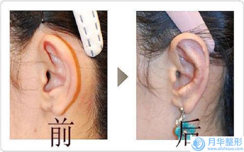 北京女性豐胸手術(shù)效果能夠保持多久