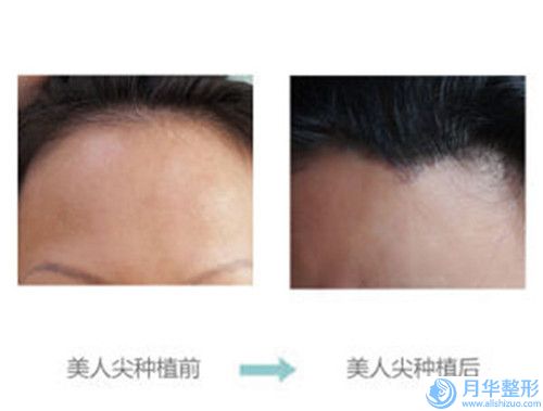 漯河市小面積洗紋身費用表明細（信息）查詢(小面積洗紋身均價為：4454元）