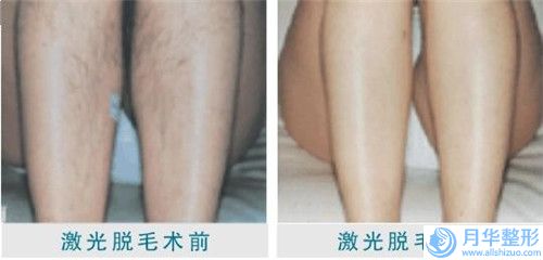 林廣興消脂瘦臉術(shù)能不能保持一輩子