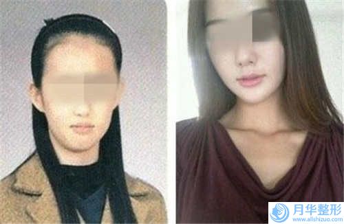 九江星瑞美醫(yī)療美容整形門診部收費明細熱門完整出爐-下巴假體歪案例