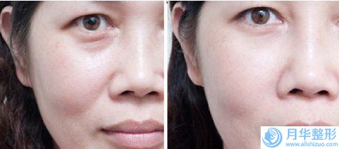 大連檸檬女士醫(yī)療美容整形診所收費標準官方詳細曝光-刀疤痕去修復案例