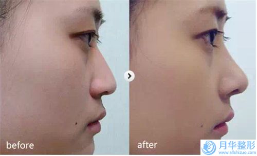 齊齊哈爾天大整形美容診所線(xiàn)調(diào)隆鼻整形費(fèi)用是多少
