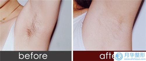 豐滿趙鋼醫(yī)療美容產(chǎn)臉上斑去除費(fèi)用要支付多少