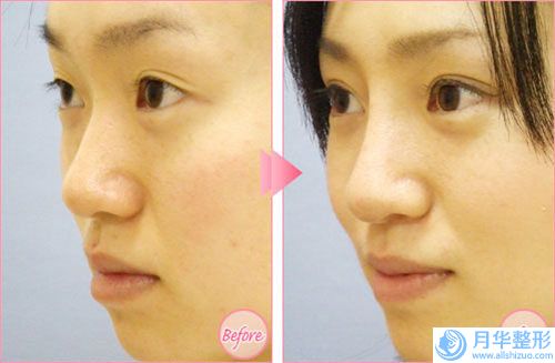 大慶皮膚病醫(yī)院價(jià)格(價(jià)目)官方更新辣-骨粉隆鼻子案例