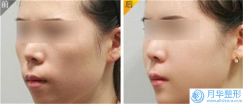 深圳唇裂嚴(yán)重的價(jià)格一般貴不貴