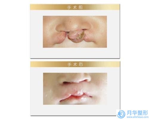 遼源市下巴收縮矯正價(jià)位表解析(近6個(gè)月均價(jià)為：17315元)