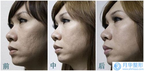 威海打蘋果肌價(jià)格你了解嗎