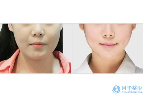 白山清華醫(yī)學(xué)美容診所整形價(jià)格價(jià)位表曝出-歪下巴案例