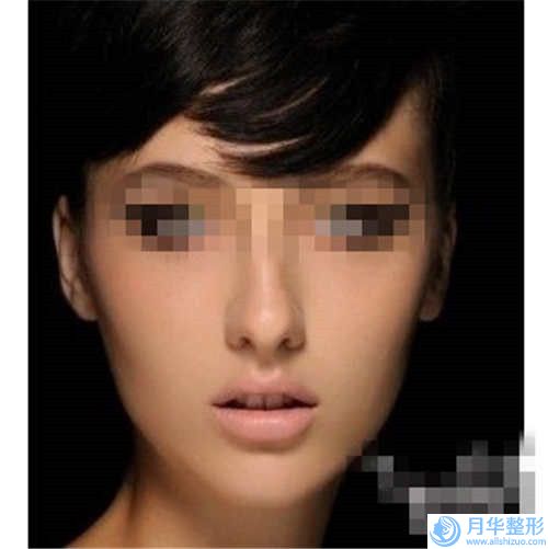長春紅寶石醫(yī)療美容整形收費標(biāo)準(zhǔn)口碑詳細-自體脂肪填充墊下巴案例