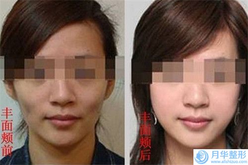 福州千慕醫(yī)療美容門診部價格收費(fèi)表2025版全新公開-線雕去除眉間紋案例