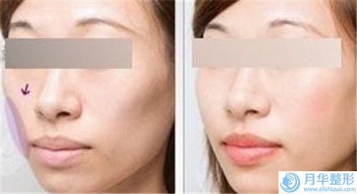 中國切眉提拉術(shù)好醫(yī)生：切眉提拉術(shù)醫(yī)生前50都是哪些上榜