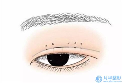 拉薩修復(fù)眼袋外翻美容做一次可以維持多久