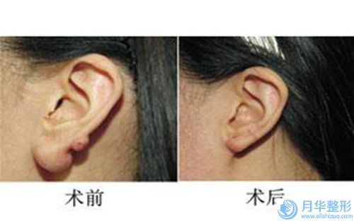 來賓智齒拔除手術(shù)會不會影響到生育和哺乳