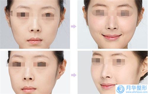 永安鴻熙妍醫(yī)療美容診所價(jià)格(價(jià)目)表好不好-鼻中隔偏曲隆鼻矯正案例