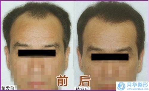 七臺河冠橋義齒會不會傷害到面部神經(jīng)血管