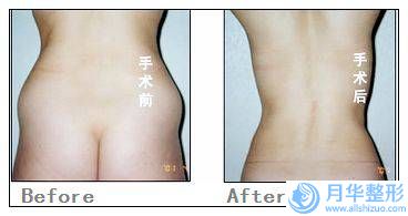 杭州藝星醫(yī)療美容醫(yī)院整形收費明細優(yōu)惠在線預覽-顴弓顴骨整形案例