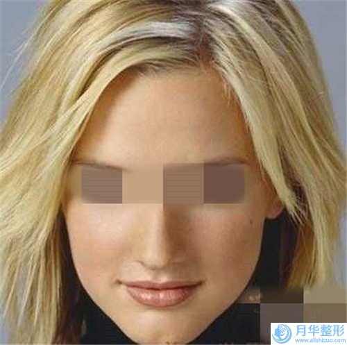 濟南豐下巴玻尿酸的禁忌癥和適應(yīng)人群